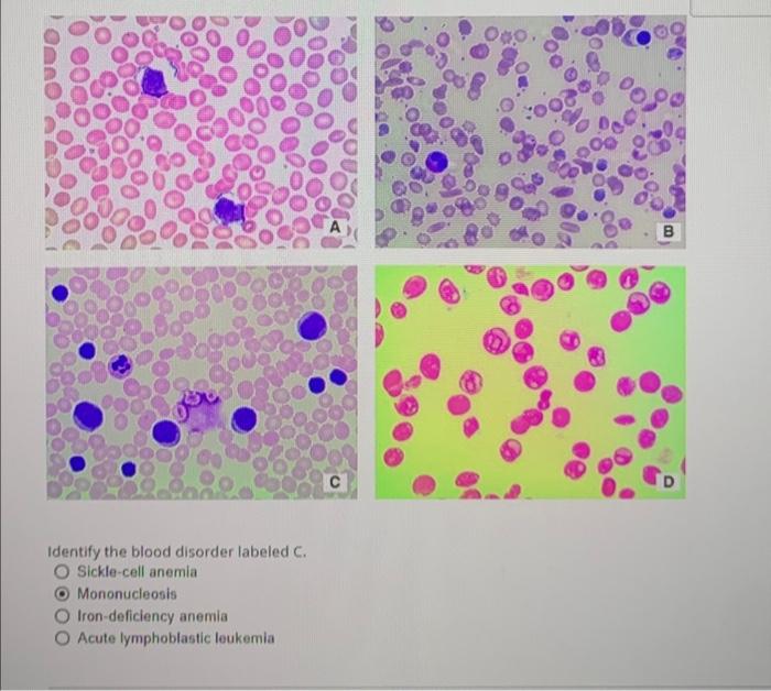 Solved Identify the blood disorder labeled C. Sicklecell