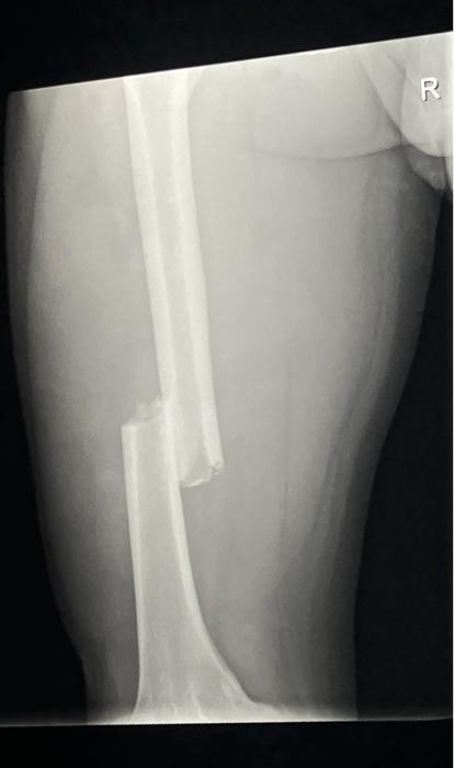 Solved Case presentation of mid femoral shaft fracture with | Chegg.com