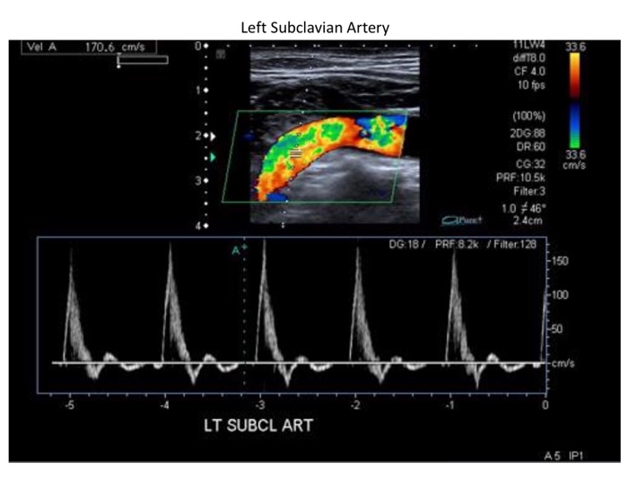Узи верхних. Спектральное окно в допплерографии. Исследование подключичной артерии на УЗИ. Допплерография подключичных артерий. Спектр артерии на УЗИ.