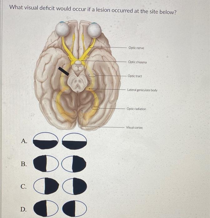 Solved What visual deficit would occur if a lesion occurred | Chegg.com