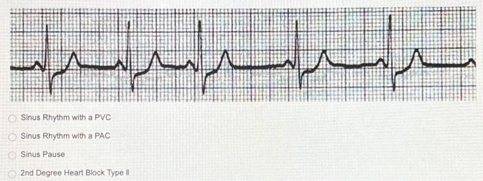 Ventricular Fibrillation Sinus Tachycardia | Chegg.com