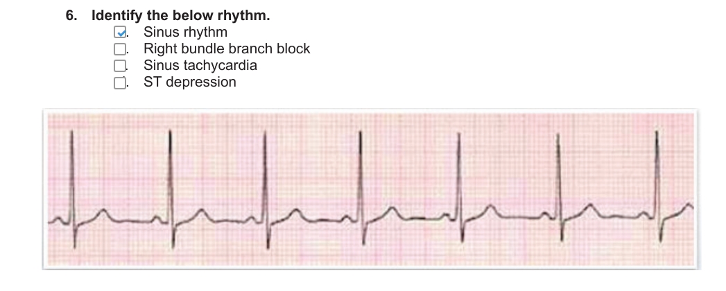 Solved Identify The Below Rhythm.sinus Rhythmright Bundle 