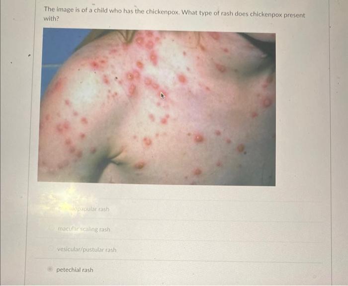 The image is of a child who has the chickenpox. What | Chegg.com