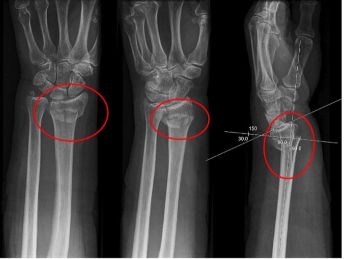 Solved This is a typical (dinner fork) fracture.what bone
