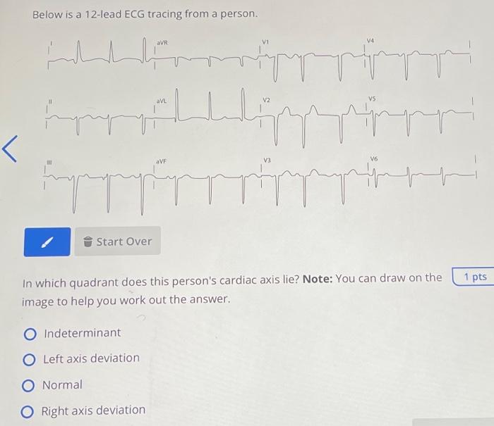 Solved ECG You can draw on this limb lead axes diagram to | Chegg.com