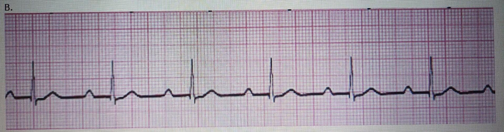 Solved What Is The Rhythm Of This Strip? | Chegg.com