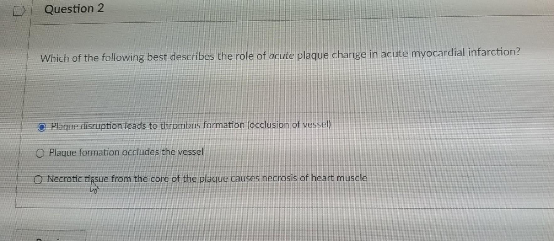 Question 2 Which of the following best describes the role of acute plaque change in acute myocardial infarction? Plaque disru