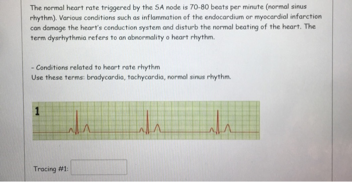 Normal Sa Function Solved The normal heart rate triggered by the SA node is | Chegg.com