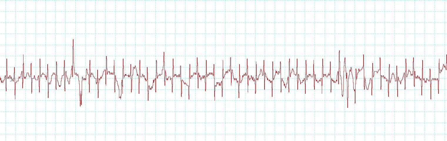 Solved Aortic area: Describe the shape of the S1 ﻿& S2 | Chegg.com