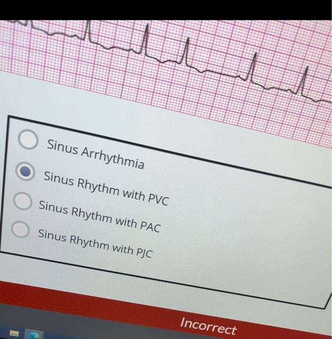 Sinus Arrhythmia Sinus Rhythm with PVC Sinus Rhythm | Chegg.com