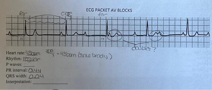 Solved ECG PACKET AV BLOCKS Heart rate: 43bpm7360=43bam | Chegg.com