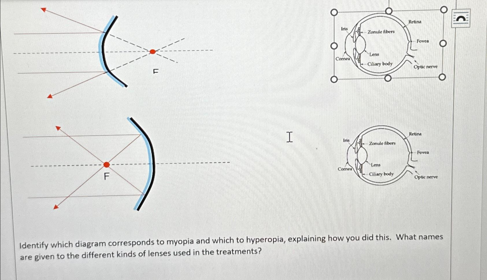 Solved Identify which diagram corresponds to myopia and | Chegg.com
