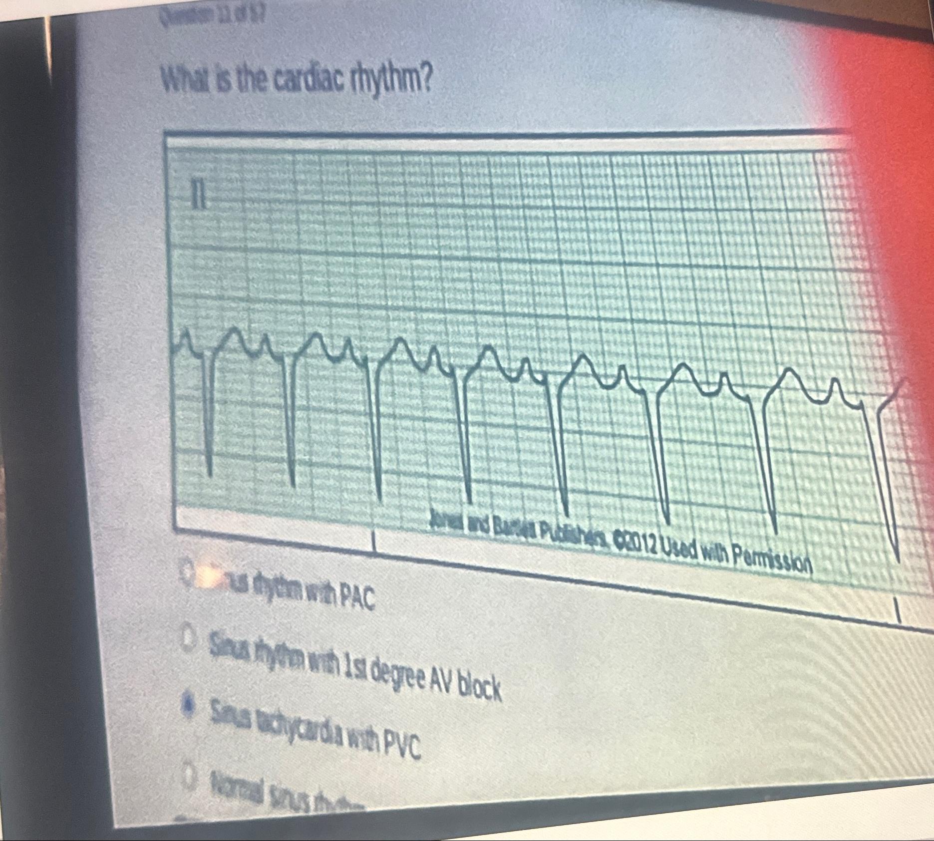 Solved What is the cardiac rhythm?Sinus rhythm with PAC. | Chegg.com