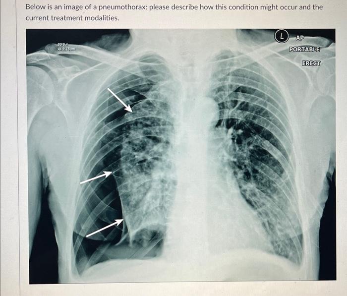 Solved Below Is An Image Of A Pneumothorax: Please Describe 