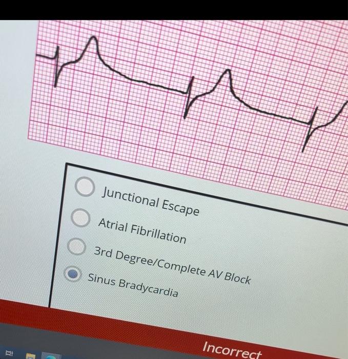 Solved Sinus Rhythm with 1st Degree AV Block 2nd Degree Type | Chegg.com