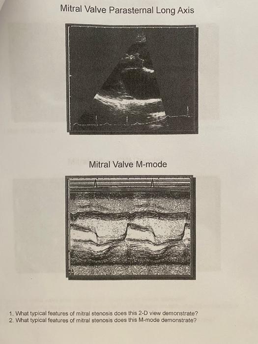 Mitral Valve Parasternal Long Axis
Mitral Valve M-mode
1. What typical features of mitral stenosis does this 2-D view demonst