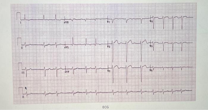 Solved What type of problem is shown in the ECG below? Acute | Chegg.com