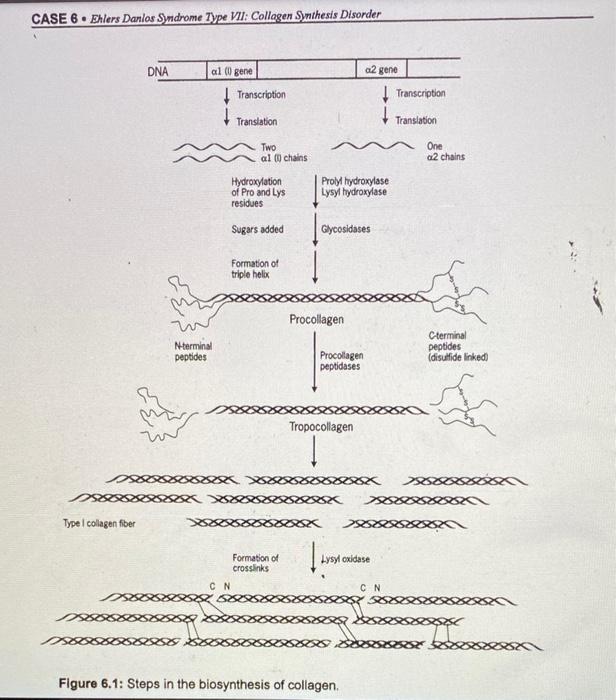 Solved UDO Ehlers Danlos Syndrome Type VII Collagen