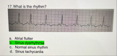 Solved What is the rhythm?a. ﻿Atrial flutterb. ﻿Sinus | Chegg.com