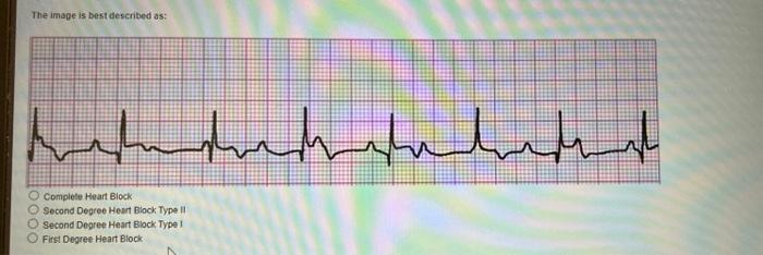 Solved The Image Is Best Described As: Complele Heart Block 