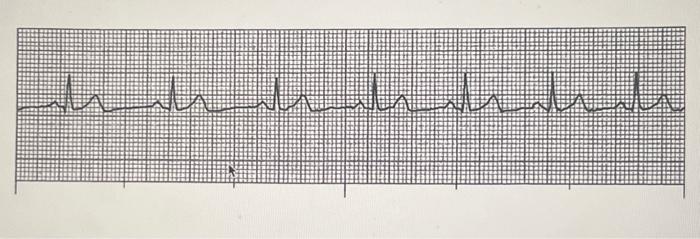 Solved 1 .ventricular Rate /Rhythm---- Atrial Rate / | Chegg.com