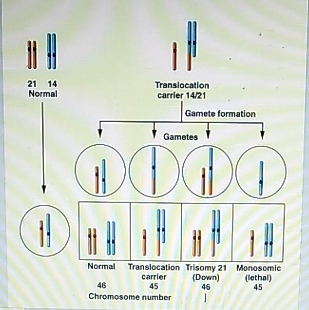 Solved di 21 14 Normal Translocation carrier 14/21 Gamete | Chegg.com