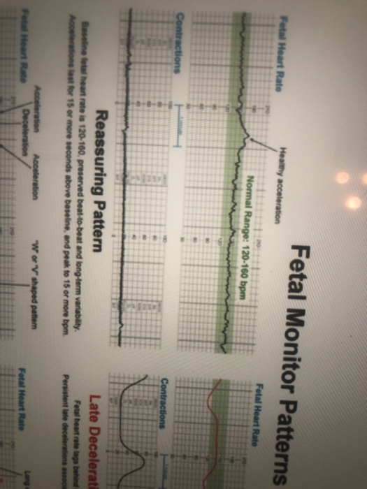 Solved Fetal Monitor Patterns Near Cocos Reassuring Patte Chegg Com