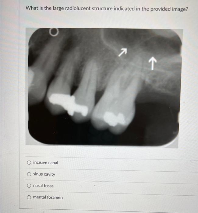 What is the large radiolucent structure indicated in