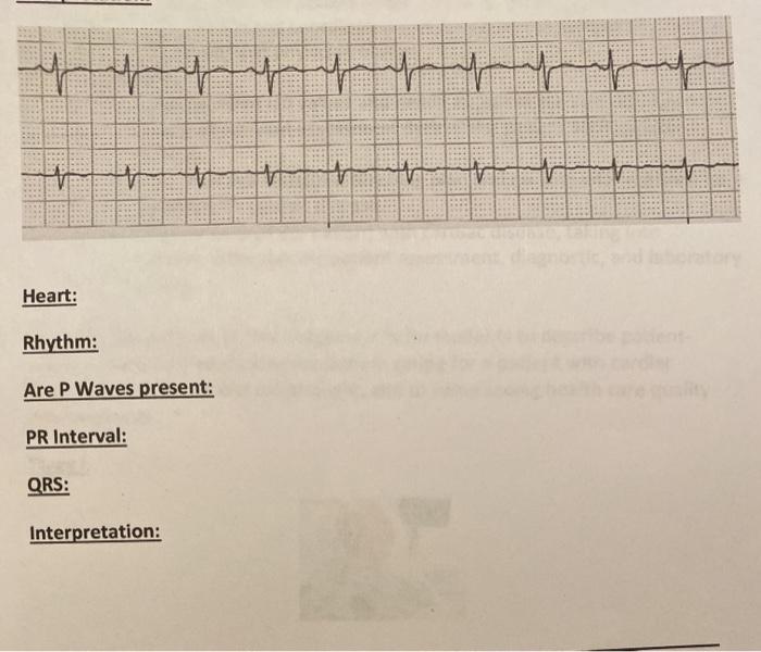 السلام العالم المال المسلسل + لے Heart: Rhythm: Are P Waves present: PR Interval: : QRS: Interpretation: