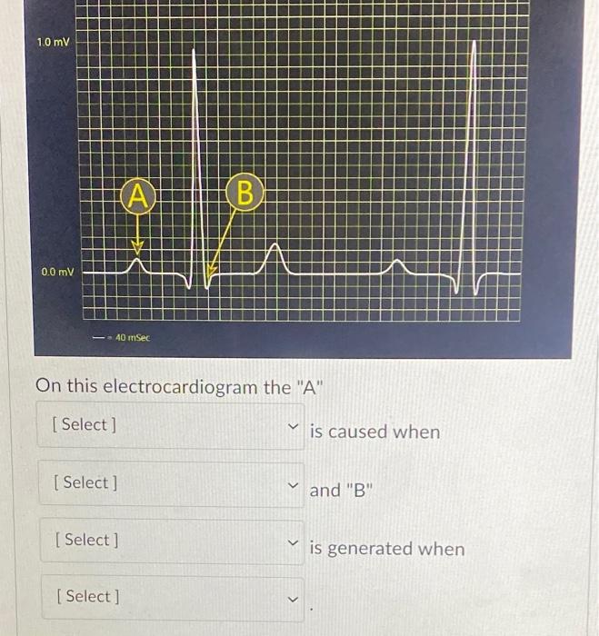 Solved On This Electrocardiogram The "A" Is Caused When And | Chegg.com