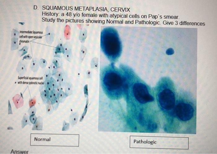 D. SQUAMOUS METAPLASIA, CERVIX History: a 48 y/o female with atypical cells on Paps smear. Studv the nicturns chnwing Normal