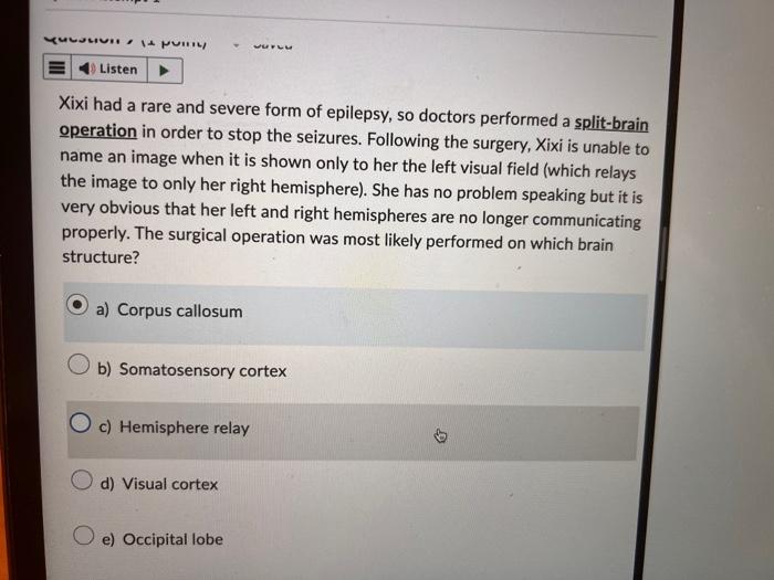 Solved Xixi had a rare and severe form of epilepsy, so | Chegg.com