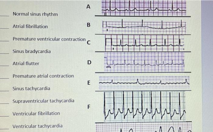 ventricular tachycardia vs supraventricular tachycardia