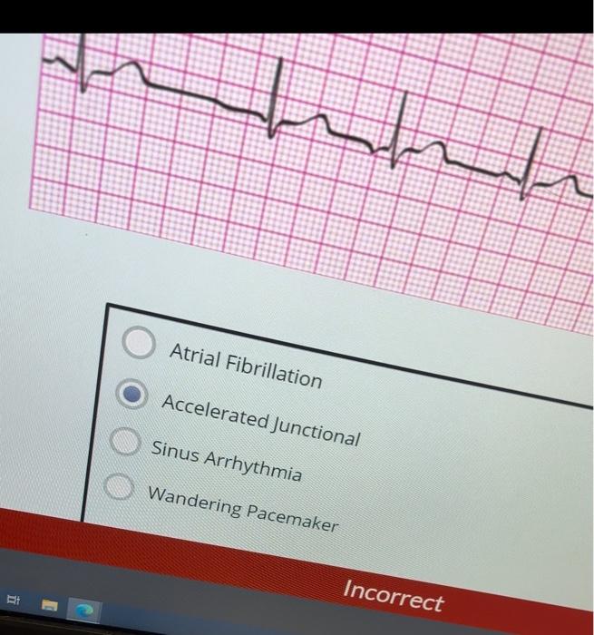 Solved Sinus Rhythm with 1st Degree AV Block 2nd Degree Type | Chegg.com