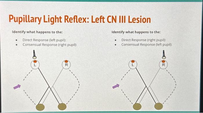 Solved Pupillary Light Reflex: Left CN III Lesion | Chegg.com