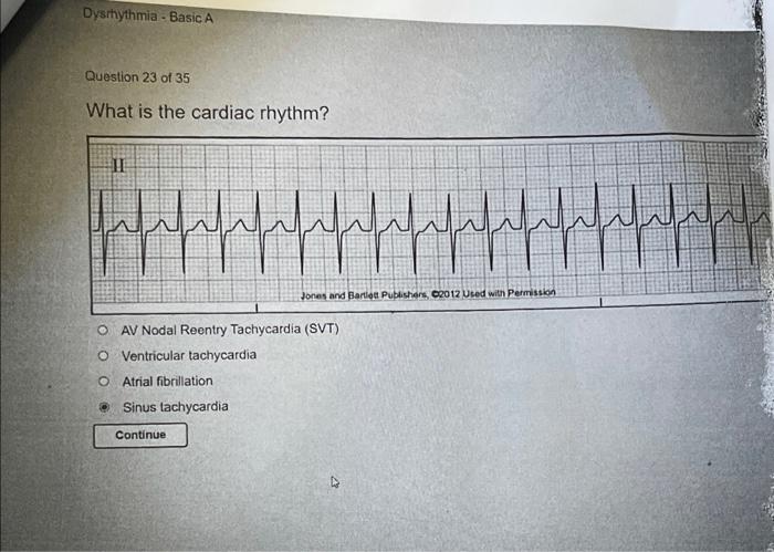 solved-dysrhythmia-basic-a-question-21-of-35-what-is-the-chegg