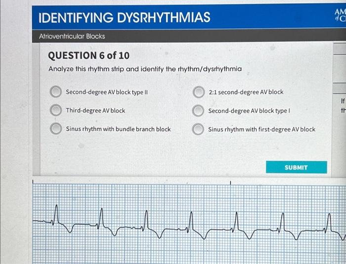 Solved IDENTIFYING DYSRHYTHMIAS Atrioventricular Blocks