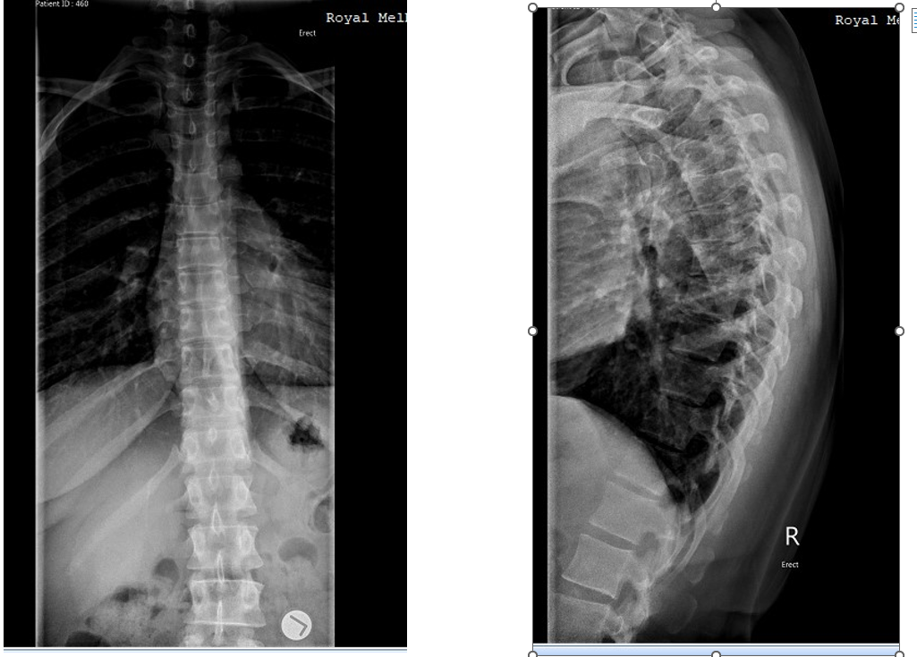 Solved AP Thoracic SpineLateral Thoracic SpineThis case is | Chegg.com