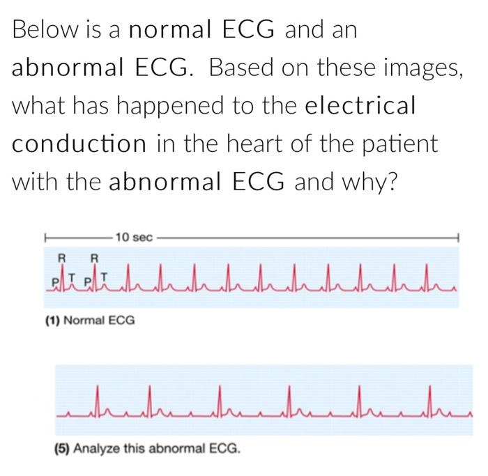 normal vs abnormal ecg