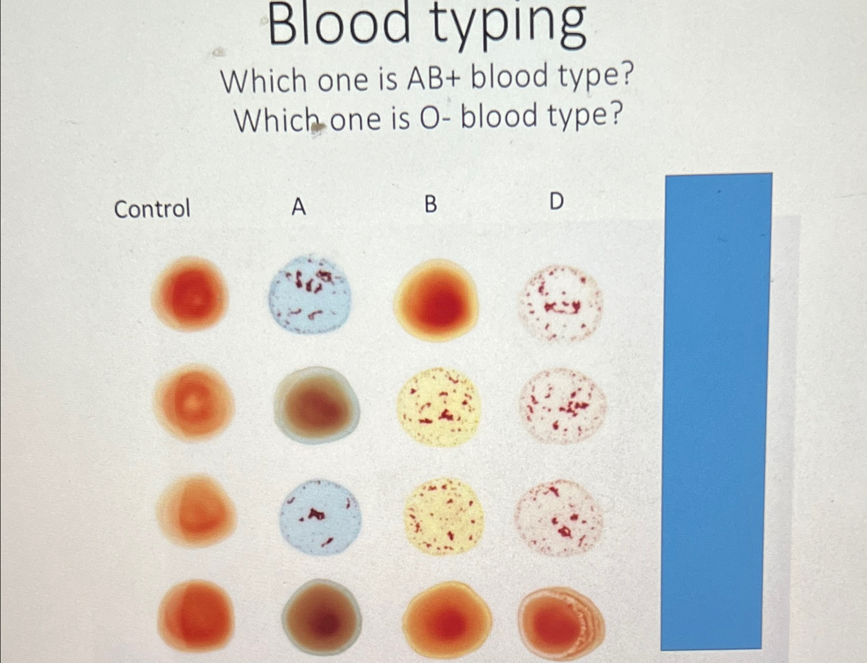 Blood typingWhich one is AB+ ﻿blood type?Which one is