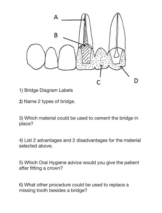 1) Briage viagram Lade?s
2) Name 2 types of bridge.
3) Which material could be used to cement the bridge in place?
4) List 2 