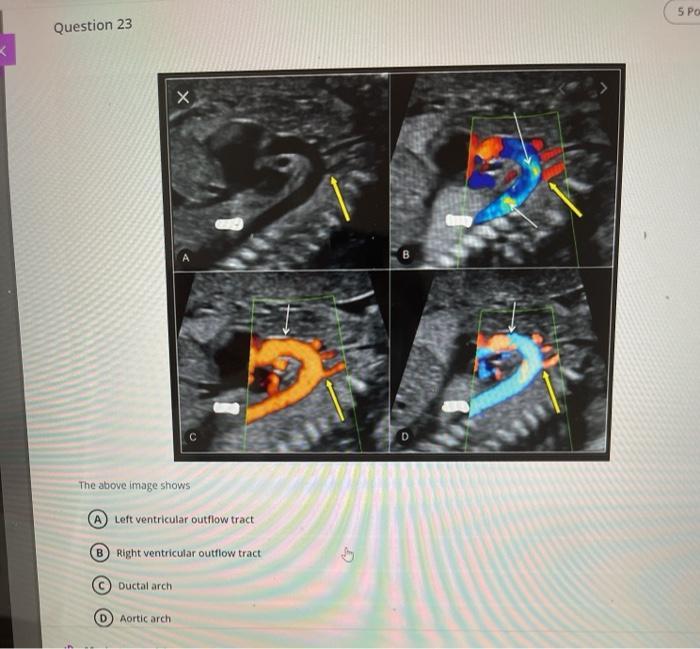 5 Po Question 23 х D The above image shows Left ventricular outflow tract Right ventricular outflow tract Ductal arch Aortic