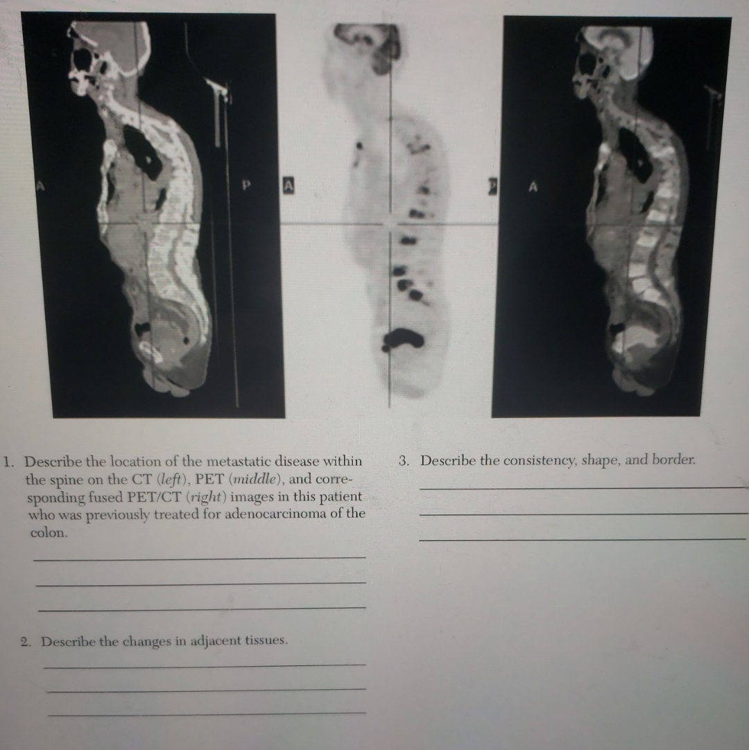 Solved Describe the location of the metastatic disease | Chegg.com