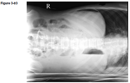 Child Anteroposterior Projection Left Lateral Decubitus Chegg Com