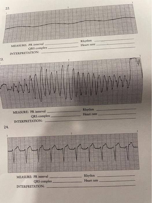 QRS complex INTERPRETATION MEASURE PR interval