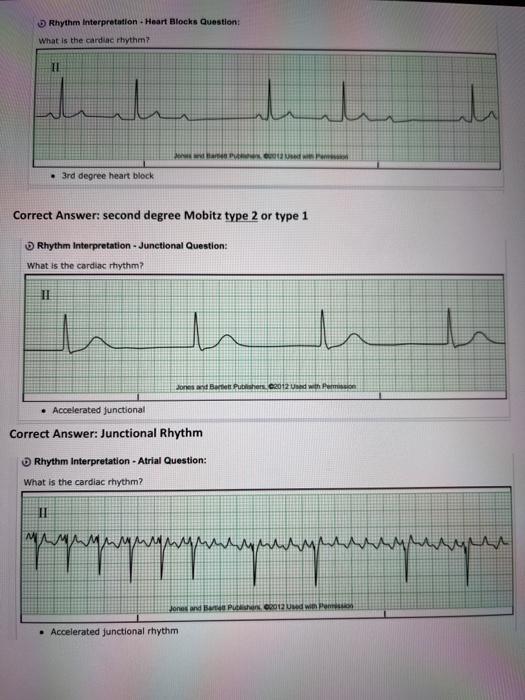 Rhythm interpretation. Heart Blocks Question What is