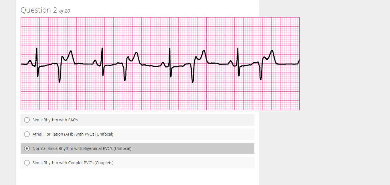 Solved Question 2:Sinus Rhythm with PAC'sAtrial Fibrillation | Chegg.com