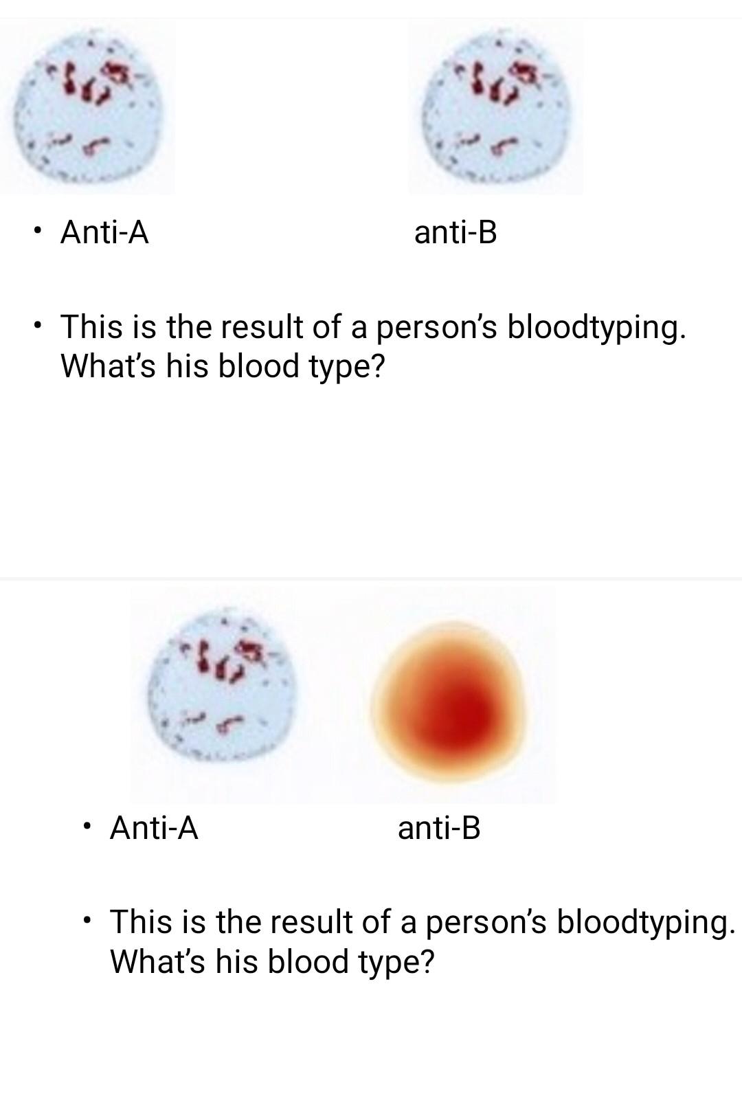 Solved $ Anti-A Anti-B This Is The Result Of A Person's | Chegg.com