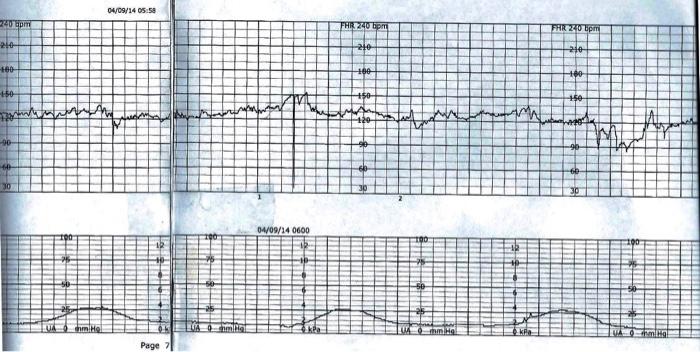 04/09/14 05:58 40 pm FHR240 pm FHR 20 bpm 210 210 20 160 160 100 150 +50 150 W 30 04/09/14 0600 mo Cm ma ming Page 7