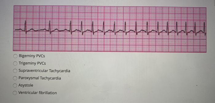 Solved مل اے ایام محرم اسرار ماہ Bigeminy PVC Trigeminy PVCS | Chegg.com